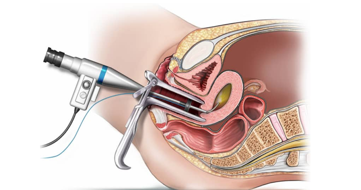 Hysteroscopy is a procedure in which a thin telescope-like instrument (hysteroscope) is passed through the vagina and cervix into the uterus