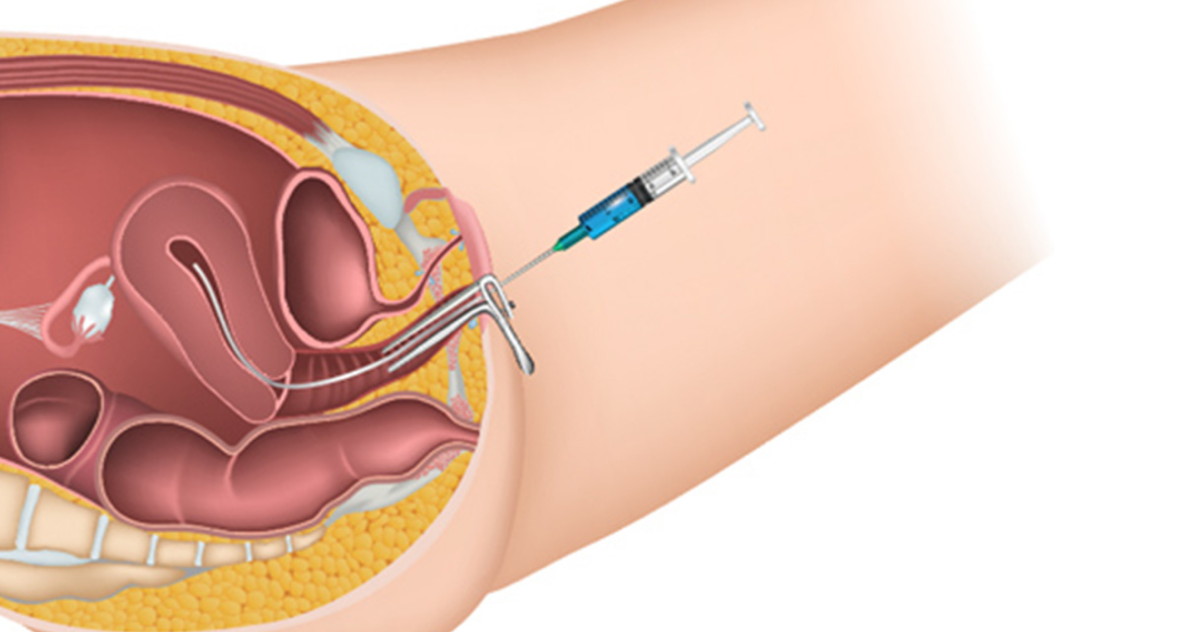 Trusted IUI Fertility Centre in Anna Nagar