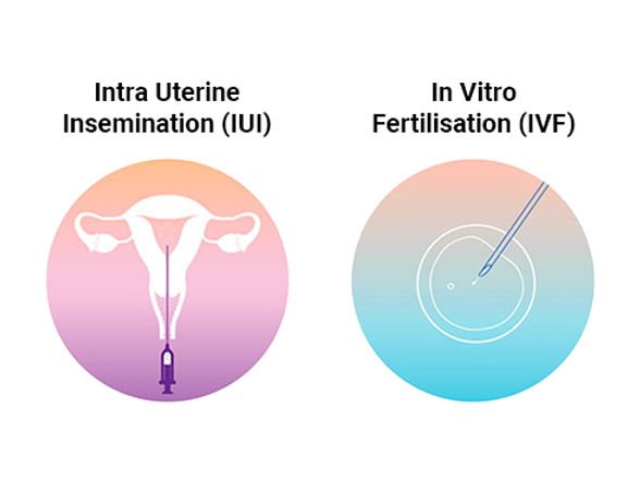 iui vs ivf treatment